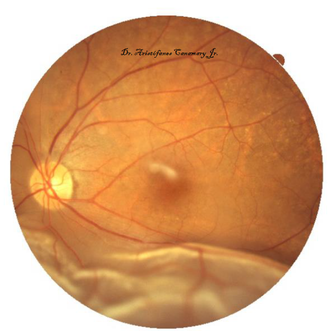 Descolamento Retina CAC